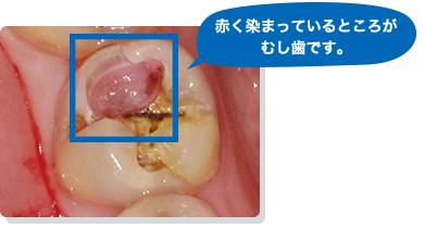 赤く染まっているところがむし歯です。